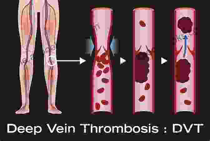 DVT Formation And Its Consequences Practical Phlebology: Deep Vein Thrombosis