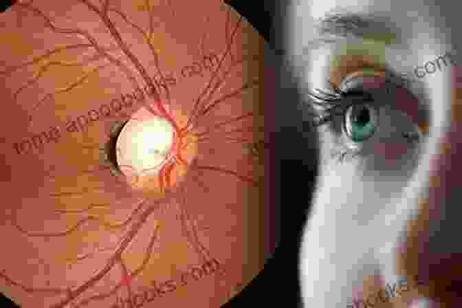 Eye Affected By Glaucoma Minimally Invasive Glaucoma Surgery Avesta Alani