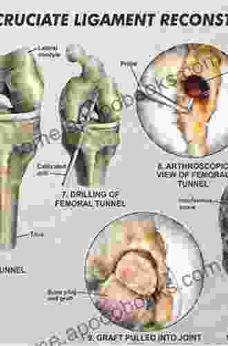 Anterior Cruciate Ligament Reconstruction: A Practical Surgical Guide