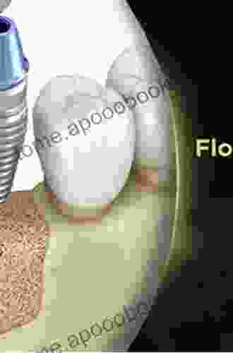 Bone Management In Dental Implantology